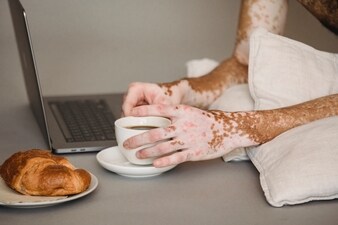 Mental wellbeing of patients who have Vitiligo: Tips, tricks, ways to motivate patients (Photo by Armin Rimoldi on Pexels) Mental wellbeing of patients who have Vitiligo: Tips, tricks, ways to motivate patients (Photo by Armin Rimoldi on Pexels)