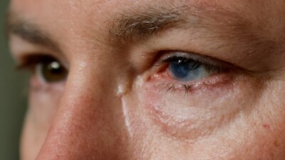 A person, who has undergone an experimental stem cell procedure with his eyes, sits for a portrait. (AP) A person, who has undergone an experimental stem cell procedure with his eyes, sits for a portrait. (AP)