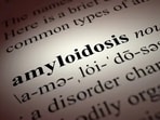 Factors for advanced stage AL amyloidosis outcomes: Study