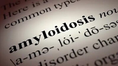 Factors for advanced stage AL amyloidosis outcomes: Study (Unsplash) Factors for advanced stage AL amyloidosis outcomes: Study (Unsplash)