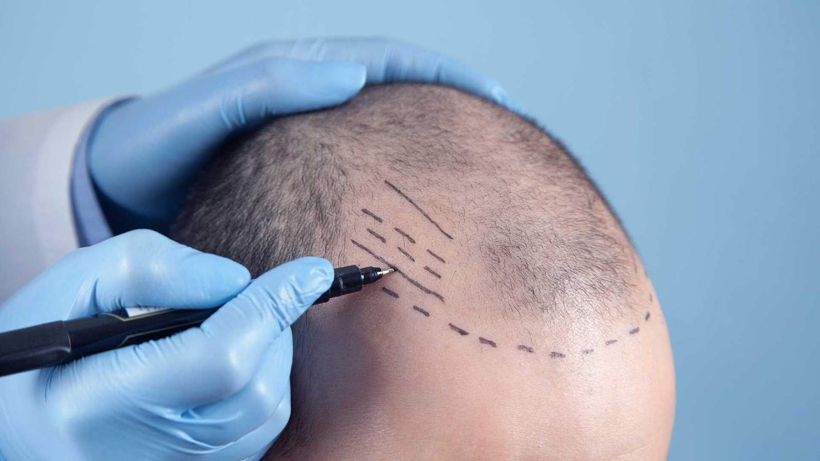 Top 15 Hair Transplant Clinics in Istanbul and Hair Transplant Packages for 2023 - Vimarsana News