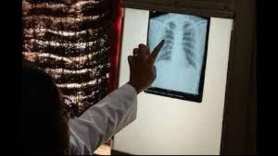 Chandigarh administration has set a goal to make the UT tuberculosis free by 2024 through a comprehensive approach. (HT PHOTO)