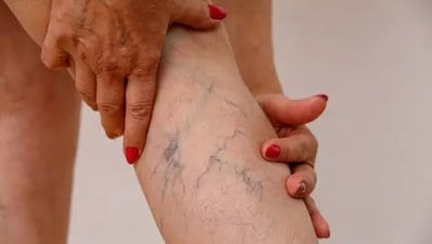 Often due to the loss of elasticity in the veins of the body, the blood travels backwards and gets the veins swollen. This leads to varicose veins – enlarged, swollen twisting veins usually blue or dark purple in colour. Some of the reasons for varicose veins are obesity, pregnancy, lack of exercise and heredity. Nutritionist Anjali Mukerjee shared a few natural measures that can help in treating varicose veins. (Unsplash) Often due to the loss of elasticity in the veins of the body, the blood travels backwards and gets the veins swollen. This leads to varicose veins – enlarged, swollen twisting veins usually blue or dark purple in colour. Some of the reasons for varicose veins are obesity, pregnancy, lack of exercise and heredity. Nutritionist Anjali Mukerjee shared a few natural measures that can help in treating varicose veins. (Unsplash)