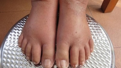 Fluid retention: Salt causes the body to retain water, leading to bloating and swelling, particularly in the hands, feet, and ankles. (Shutterstock) Fluid retention: Salt causes the body to retain water, leading to bloating and swelling, particularly in the hands, feet, and ankles. (Shutterstock)