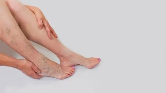 Keeping the legs at an elevated position can help the blood travel in its natural route, thereby reducing swelling in the veins.&nbsp;(Unsplash)