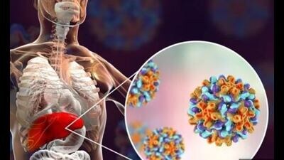 Hepatitis C is a virus that can infect the liver and cause significant and potentially fatal liver damage over time if treatment is not received. Hepatitis C is a virus that can infect the liver and cause significant and potentially fatal liver damage over time if treatment is not received.