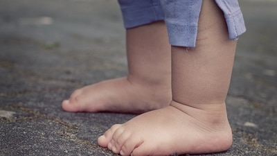 Flat foot refers to inner (medial) arches being flattened and not being visible, as we stand (Representative Image- Pixabay) Flat foot refers to inner (medial) arches being flattened and not being visible, as we stand (Representative Image- Pixabay)