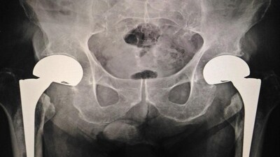 How little things can reduce hip fractures: Study (Shutterstock) How little things can reduce hip fractures: Study (Shutterstock)