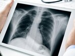 People with lung conditions face extra risks from climate change: Study