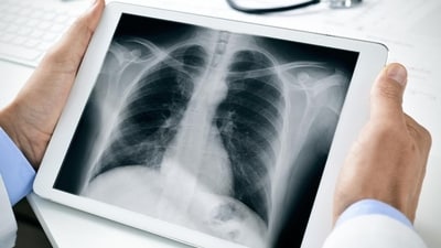 People with lung conditions face extra risks from climate change: Study (Shutterstock) People with lung conditions face extra risks from climate change: Study (Shutterstock)