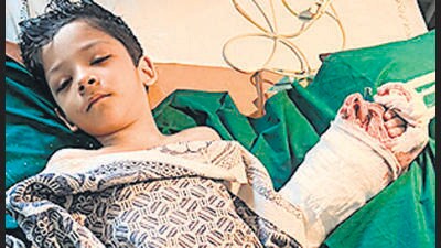 JJ Hospital doctors fix Panvel boy’s detached thumb JJ Hospital doctors fix Panvel boy’s detached thumb