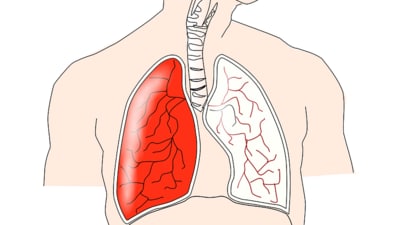 Color of phlegm may predict outcomes for patients with lung disease, bronchiectasis: Research (Image by Clker-Free-Vector-Images from Pixabay ) Color of phlegm may predict outcomes for patients with lung disease, bronchiectasis: Research (Image by Clker-Free-Vector-Images from Pixabay )