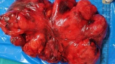Delhi NCR doctors remove 1.9 kgs tumour from 17-year-old patient’s chest cavity (Photo by Fortis Healthcare Ltd) Delhi NCR doctors remove 1.9 kgs tumour from 17-year-old patient’s chest cavity (Photo by Fortis Healthcare Ltd)