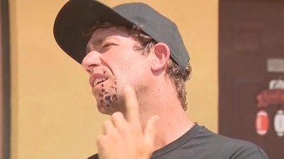 Mark Summerset, the North Carolina surfer showing his probable shark bite (WSVN) Mark Summerset, the North Carolina surfer showing his probable shark bite (WSVN)