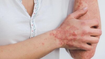 Psoriasis is a chronic inflammatory immune-mediated illness that affects 1-3% of the global population. (World Psoriasis Day) Psoriasis is a chronic inflammatory immune-mediated illness that affects 1-3% of the global population. (World Psoriasis Day)