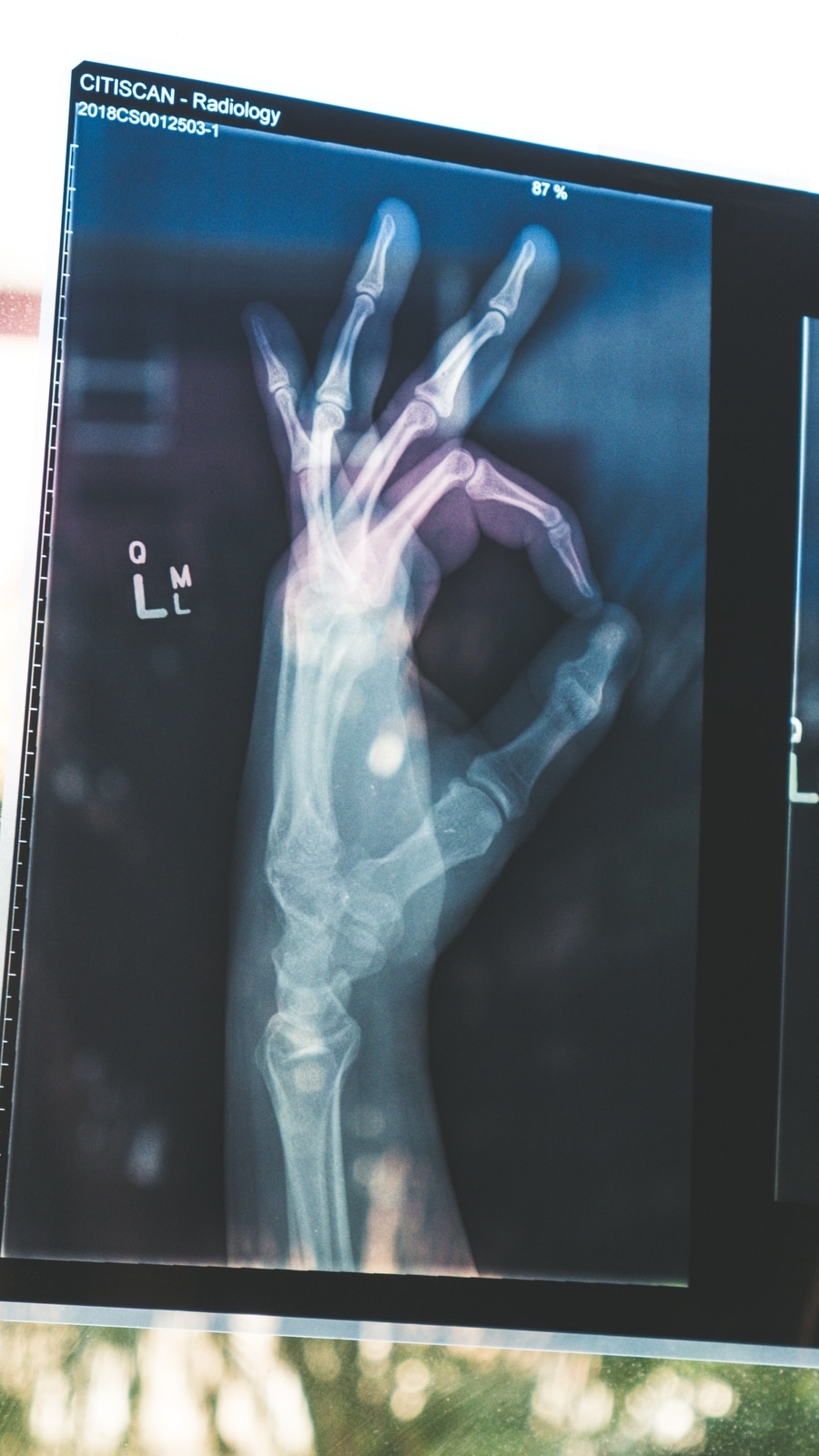 5_foods_to_prevent_osteoporosis