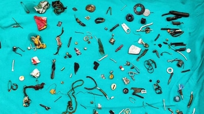 After a three-hour long surgery, doctors were able to remove the items from his body. (X) After a three-hour long surgery, doctors were able to remove the items from his body. (X)