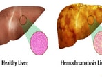 What is Hemochromatosis, the rare genetic disorder that causes organ dysfunction? What is Hemochromatosis, the rare genetic disorder that causes organ dysfunction?