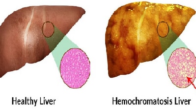 What is Hemochromatosis, the rare genetic disorder that causes organ dysfunction? (Photo by Twitter/icarebilling) What is Hemochromatosis, the rare genetic disorder that causes organ dysfunction? (Photo by Twitter/icarebilling)