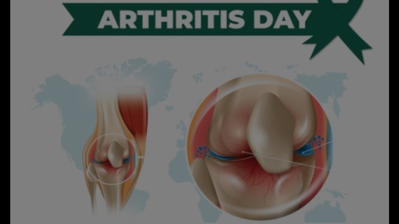 World Arthritis Day: 'Irrational steroid use during pandemic spoiled joints' - Vimarsana News