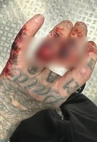 Travis Barker's injury (Instagram/@travisbarker) Travis Barker's injury (Instagram/@travisbarker)