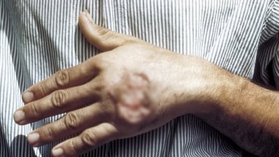 Genetic testing of 86 locally acquired cases showed that the majority were infected by a variant of the Leishmania mexicana parasite that may have originated in the US. (Wikipedia) Genetic testing of 86 locally acquired cases showed that the majority were infected by a variant of the Leishmania mexicana parasite that may have originated in the US. (Wikipedia)