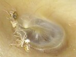 Spider seen crawling inside woman's ear. Spider seen crawling inside woman's ear.