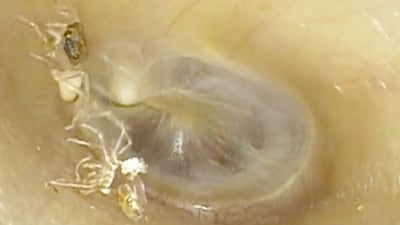 Spider seen crawling inside woman's ear. (X/NEJM) Spider seen crawling inside woman's ear. (X/NEJM)