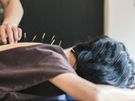 Acupuncture can help with many different types of chronic pain: Research