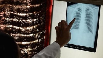 World Radiography Day 2023: Date, history, theme and significance (File photo) World Radiography Day 2023: Date, history, theme and significance (File photo)