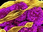 Infections caused by methicillin-resistant Staphylococcus aureus bacteria, known as MRSA, are particularly difficult to treat	