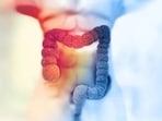 Blood transfusion requirements are reduced with iron infusion prior to bowel surgery: Study