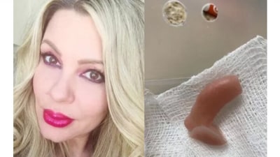Krysta blames a ‘clumsy’ injection using too much filler into a major blood vessel for causing the flesh of her nose to ‘melt off.’ Krysta blames a ‘clumsy’ injection using too much filler into a major blood vessel for causing the flesh of her nose to ‘melt off.’