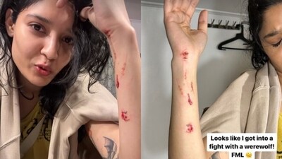 Ritika Singh shared pictures of her injuries online (Instagram) Ritika Singh shared pictures of her injuries online (Instagram)
