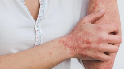Psoriasis management: Guidelines for safe sun exposure in psoriasis treatment (File Photo) Psoriasis management: Guidelines for safe sun exposure in psoriasis treatment (File Photo)