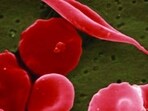 A genetic mutation causes cells to become sickle or crescent-shaped, which can block blood flow. A genetic mutation causes cells to become sickle or crescent-shaped, which can block blood flow.