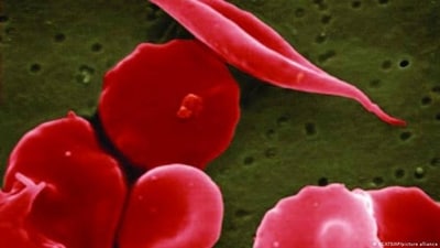 A genetic mutation causes cells to become sickle or crescent-shaped, which can block blood flow. (DW/NCATS/AP/picture alliance) A genetic mutation causes cells to become sickle or crescent-shaped, which can block blood flow. (DW/NCATS/AP/picture alliance)