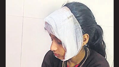 9-year-old girl injured after ceiling plaster falls off in Mumbra