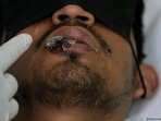 Sores and blisters, including around the mouth, are the most common mpox symptoms