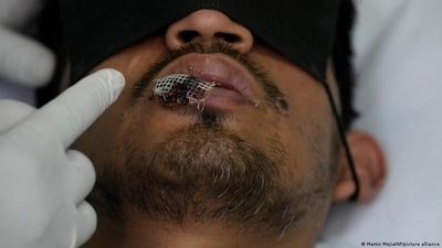 Sores and blisters, including around the mouth, are the most common mpox symptoms (Martin Mejia/AP/picture alliance) Sores and blisters, including around the mouth, are the most common mpox symptoms (Martin Mejia/AP/picture alliance)