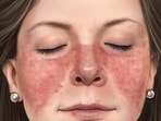 Lupus disease: Causes, symptoms, treatment and prevention tips Lupus disease: Causes, symptoms, treatment and prevention tips