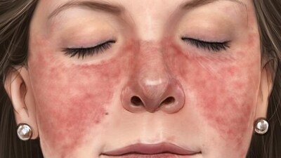 Lupus disease: Causes, symptoms, treatment and prevention tips (Photo by Twitter/DrShadyYousif1) Lupus disease: Causes, symptoms, treatment and prevention tips (Photo by Twitter/DrShadyYousif1)