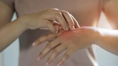 Unpleasant emotions, sensations or decision making can often trigger skin picking. Often Dermatillomania begins at early adolescence. (Unsplash) Unpleasant emotions, sensations or decision making can often trigger skin picking. Often Dermatillomania begins at early adolescence. (Unsplash)