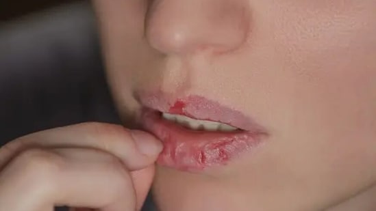 Skin picking can be picked up as a habit in an attempt to deal with stress or anxiety, and slowly lead to Dermatillomania.&nbsp;(UnsplasUnsplashh)