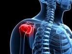 Frozen shoulder: Management and treatment options 