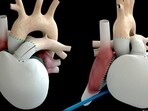 The implantation of the first Carmat heart ten years ago was hailed as a sensation. The implantation of the first Carmat heart ten years ago was hailed as a sensation.