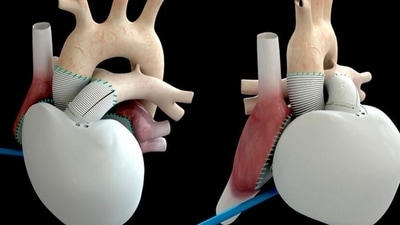 The implantation of the first Carmat heart ten years ago was hailed as a sensation. (Carmat/dpa/picture alliance) The implantation of the first Carmat heart ten years ago was hailed as a sensation. (Carmat/dpa/picture alliance)