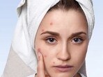 As per research published in the Journal of the American Academy of Dermatology, foods high in glycemic index have a direct impact on increasing insulin levels in the blood and can lead to excess oil secretion by the sebaceous glands, causing acne.