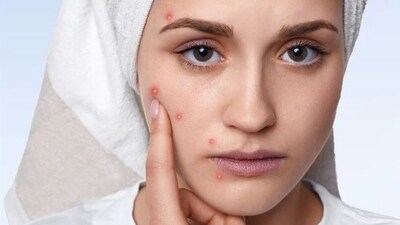 As per research published in the Journal of the American Academy of Dermatology, foods high in glycemic index have a direct impact on increasing insulin levels in the blood and can lead to excess oil secretion by the sebaceous glands, causing acne.