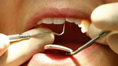 Bite correction: 3 common indications to watch out for jaw surgery (Reuters/ Representative Image) Bite correction: 3 common indications to watch out for jaw surgery (Reuters/ Representative Image)